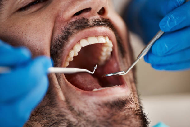 Best Emergency Dentist for Lost Fillings or Crowns in Harrisburg, NC